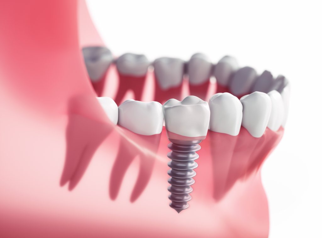 Implant dentaire Lyon combien vaut un implant dentaire Implant dentaire Lyon combien vaut un implant dentaire